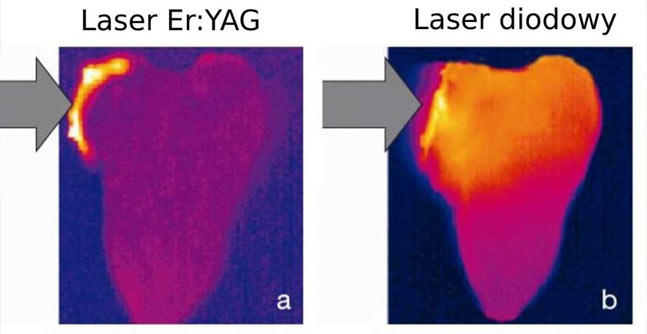 Laser Er:YAG oraz Laser diodowy