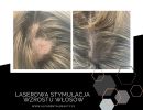 laserowa stymulacja wzrostu wlosow  