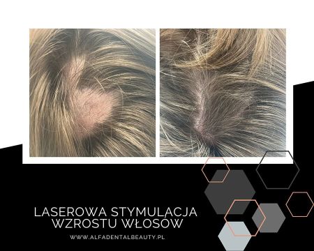 laserowa stymulacja wzrostu wlosow  