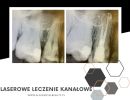 laserowe leczenie kanalowe