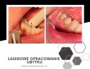 laserowe opracowanie ubytku