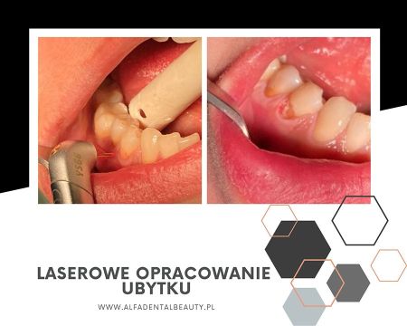 laserowe opracowanie ubytku