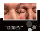 laserowe usuwanie kepek zoltych