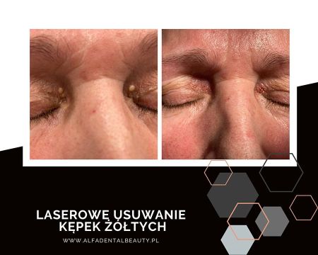 laserowe usuwanie kepek zoltych