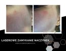 laserowe usuwanie naczyniakow  