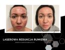 laserowe usuwanie naczyniakow  